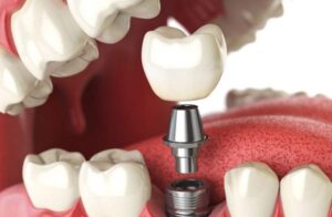 Dental-Implants-The-Future-is-Here-1