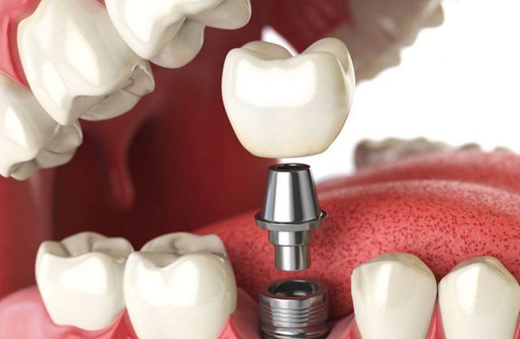 Dental Implants The Future is Here 1